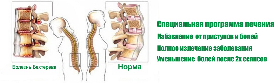 Болезнь Бехтерева